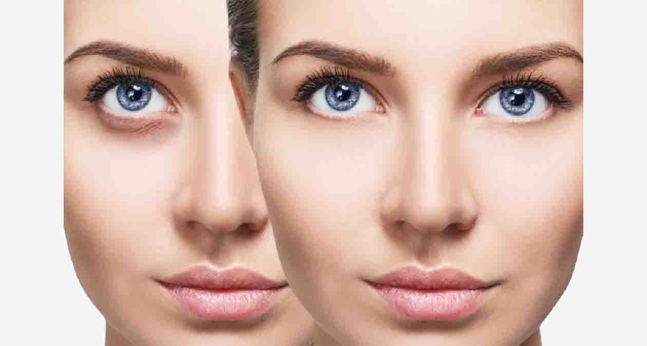 تصویر فردی قبل و بعد از استفاده از ماسک صورت خانگی برای رفع سیاهی دور چشم و لکهای صورت